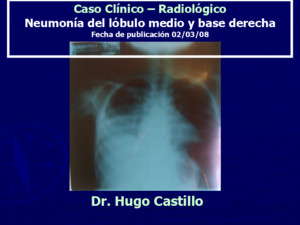 Caso Clínico – Radiológico Neumonía del lóbulo medio y base derecha Fecha de publicación 02/03/08 Dr Hugo Castillo